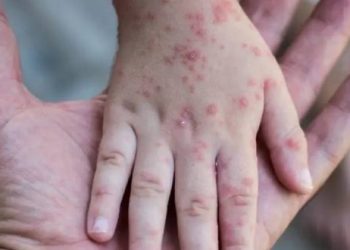 روسيا تسجل ثاني إصابة بجدري القردة في مدينة بطرسبورغ