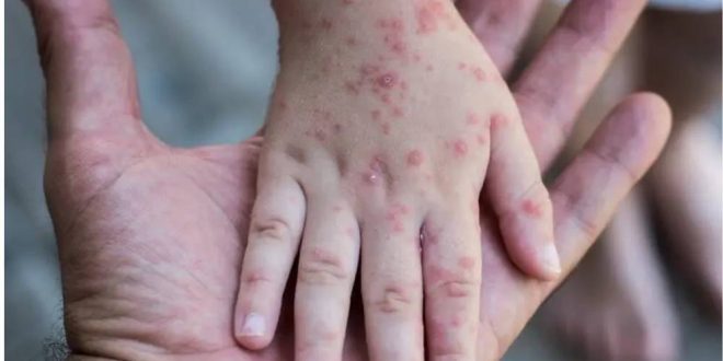 روسيا تسجل ثاني إصابة بجدري القردة في مدينة بطرسبورغ