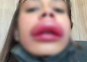 عملية تجميل فاشلة تشوه وجه فتاة بشكل غريب